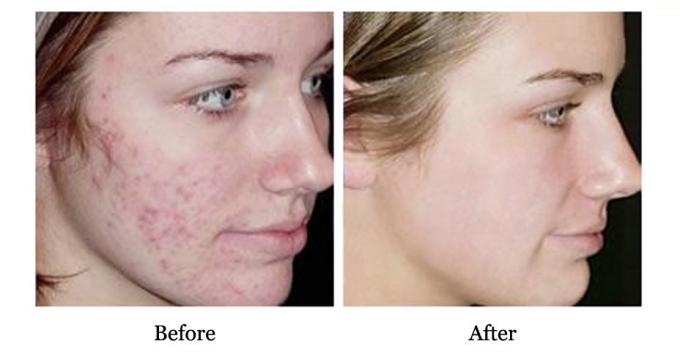 Ưu điểm của QBEKA Protein Peptide Serum giữ nước và sửa chữa sẹo mụn 10ml 6