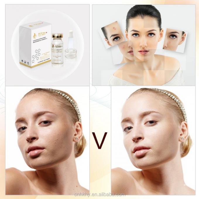Loại bỏ sẹo mụn với QBEKA Happy Cosmetics Levorotatory VC Original Liquid Bio Serum 0